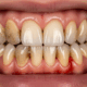 Hidden Link Between Gum Disease and Heart Health